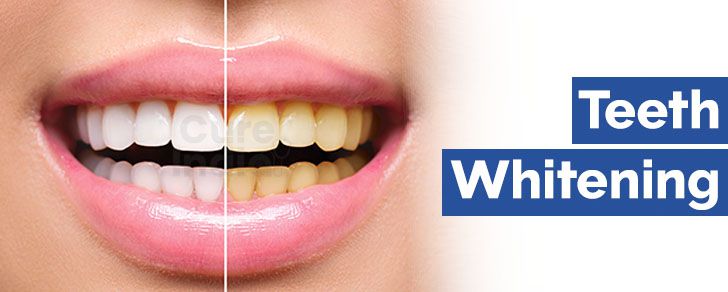 teeth-whitenning